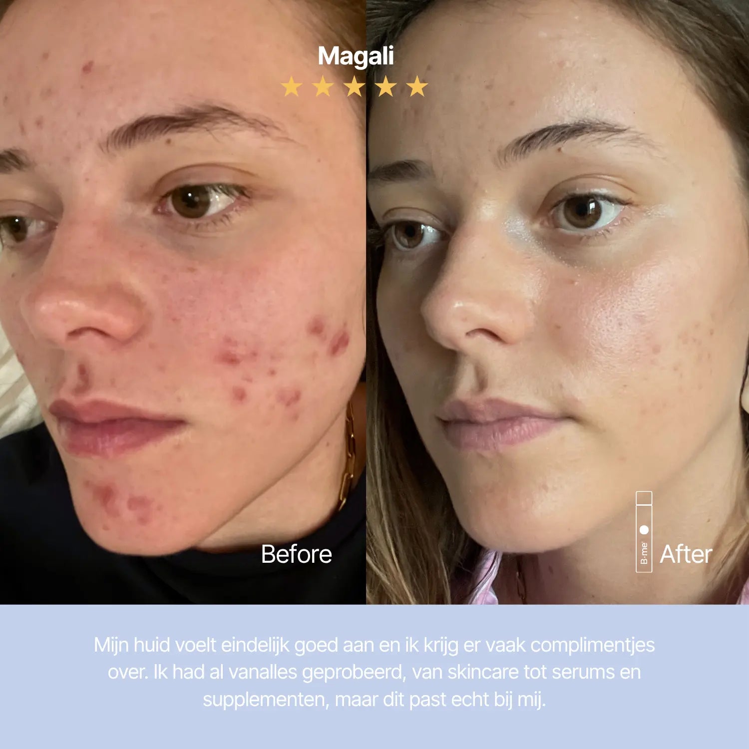 Clear skin