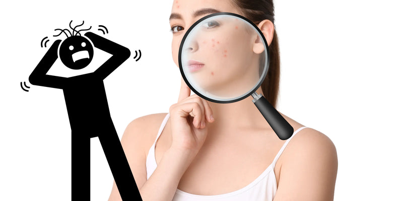 Acne-uitbarsting? Zo kalmeer je je huid van binnenuit