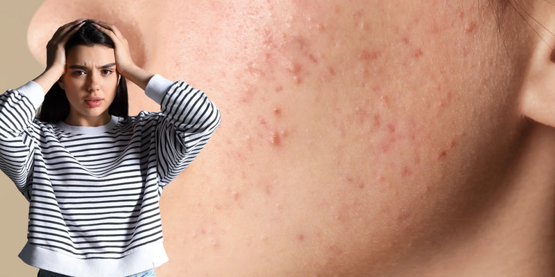 Plots last van acne? Zo ontdek je de mogelijke triggers én wat je eraan kunt doen
