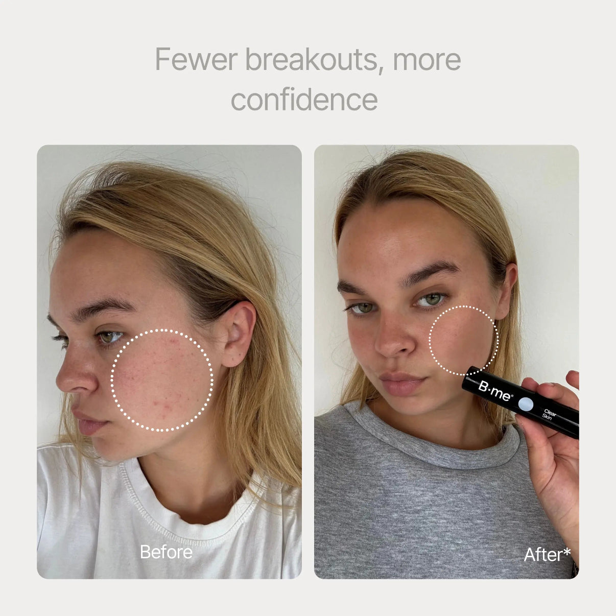 Clear skin 