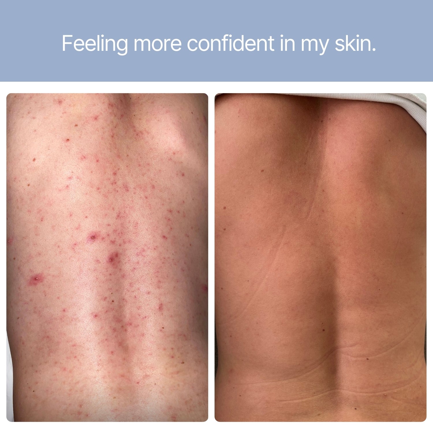 Before and after showing reduced back acne and clearer skin after using B.me Clear Skin