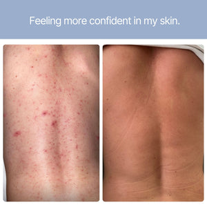 Before and after showing reduced back acne and clearer skin after using B.me Clear Skin
