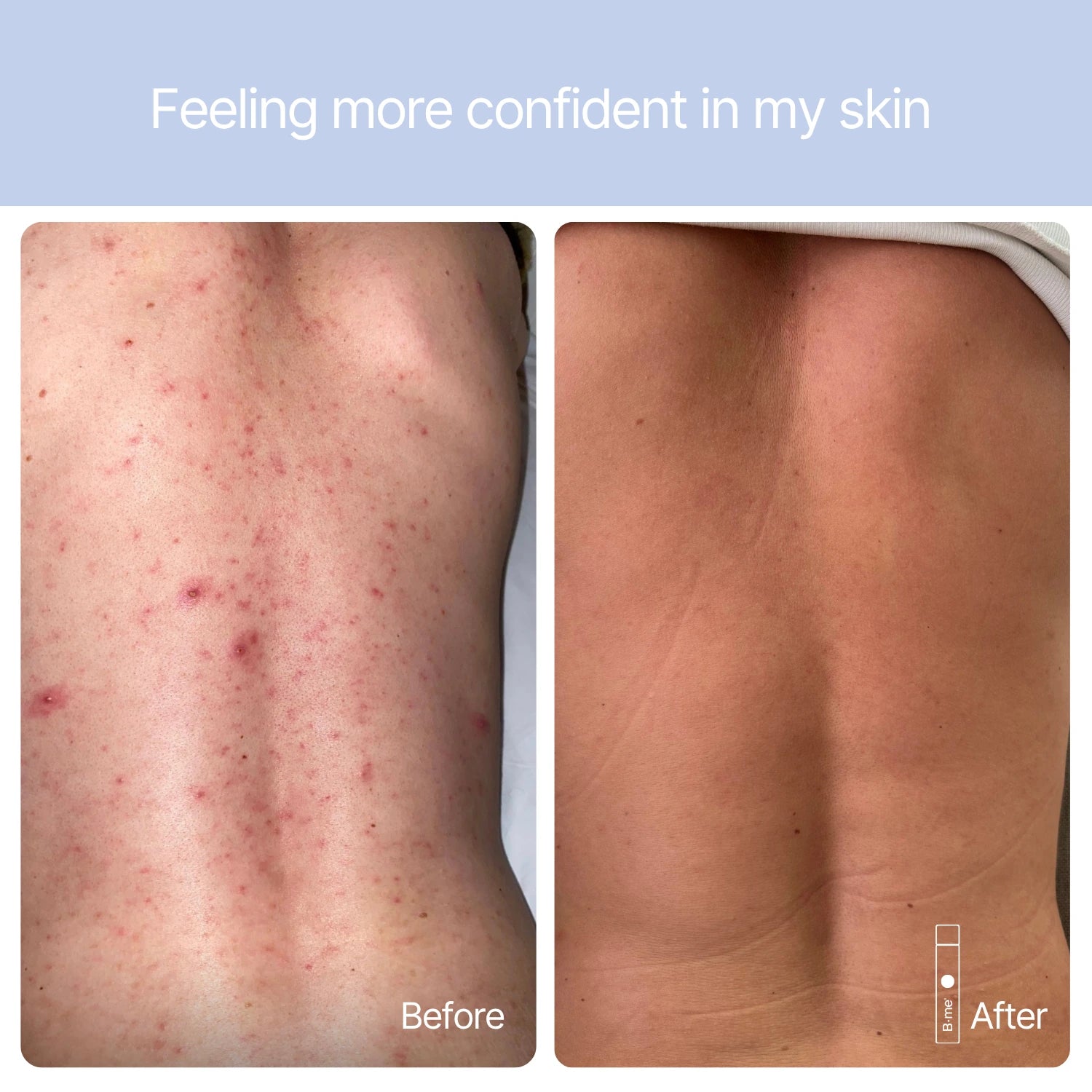 Before and after photo of back skin showing smoother appearance after using B.me Clear Skin.