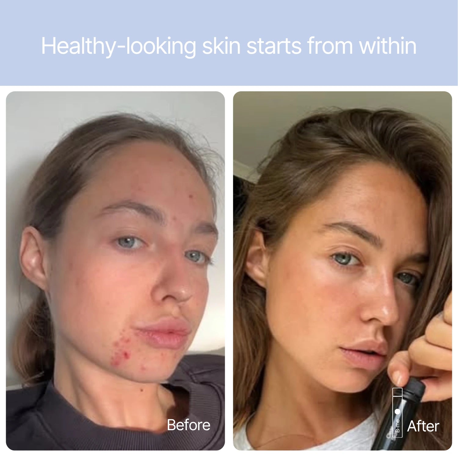 Before and after photos showing a woman’s skin looking clearer after consistent use of B.me Clear Skin.