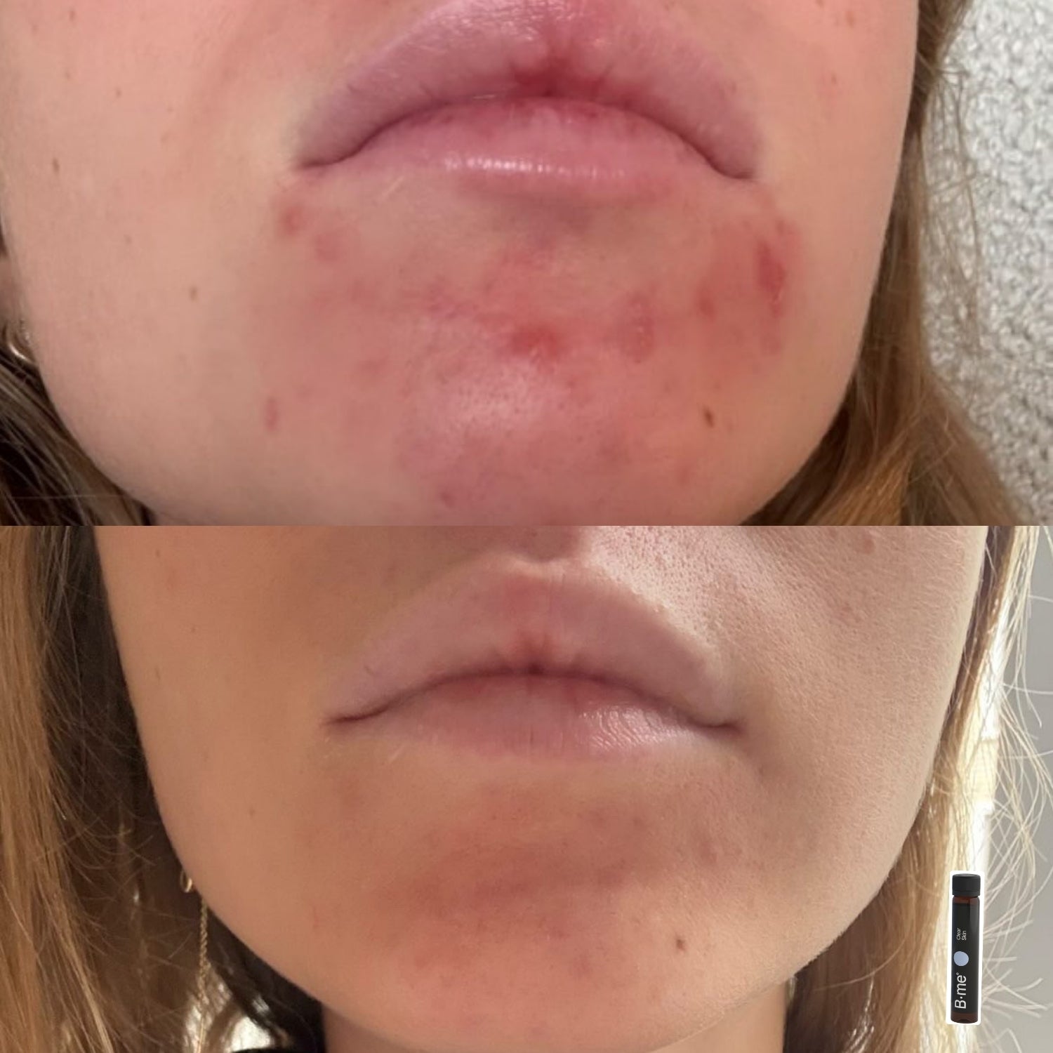 Before and after showing reduced chin acne and smoother skin after using B.me Clear Skin supplement