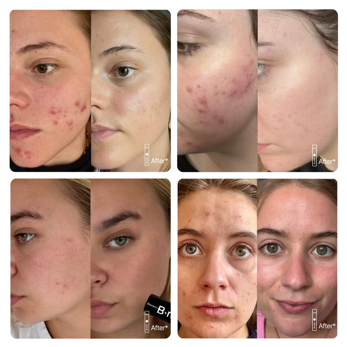 Collage of customers sharing their Clear Skin experience, showing different skin types.