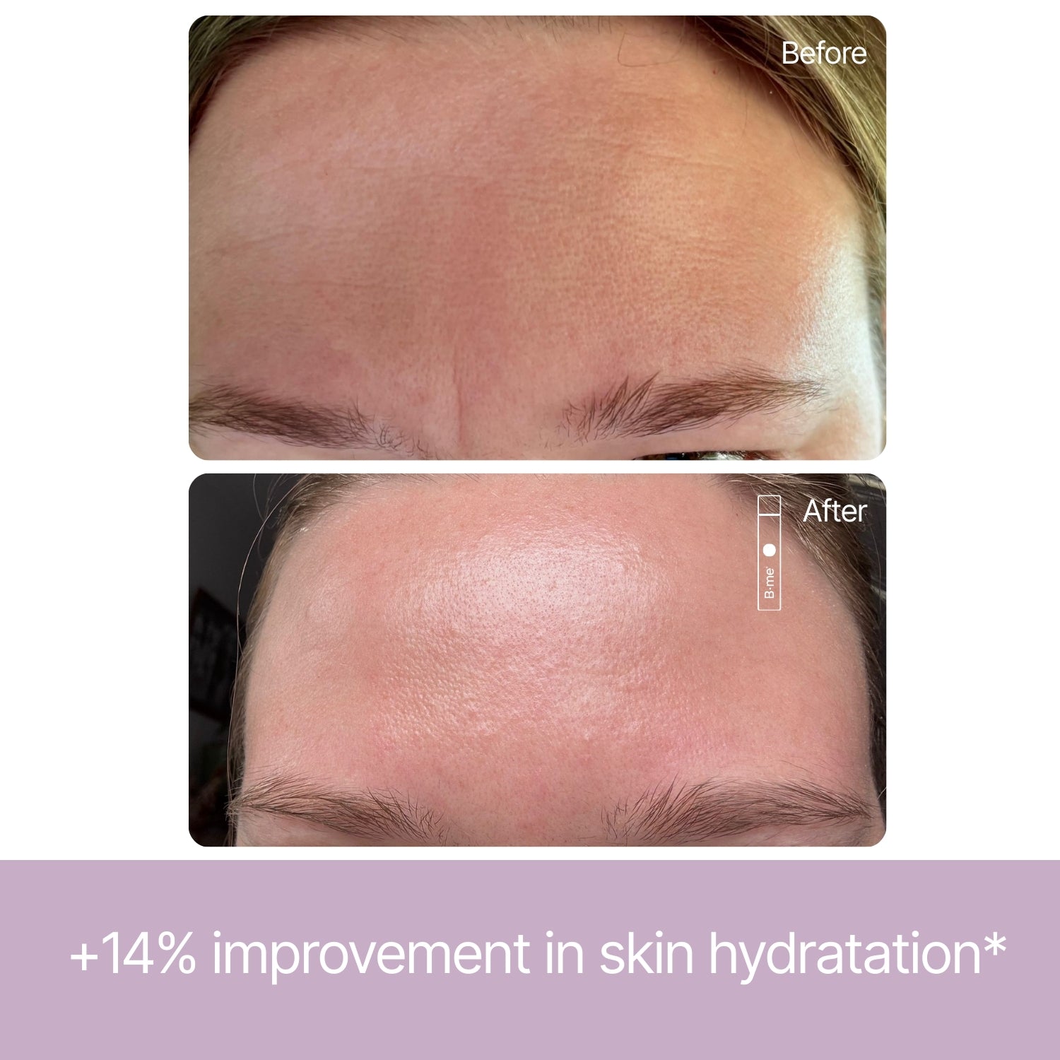 Before and after showing improved skin hydration and smoother forehead after using B.me Collagen Advance+