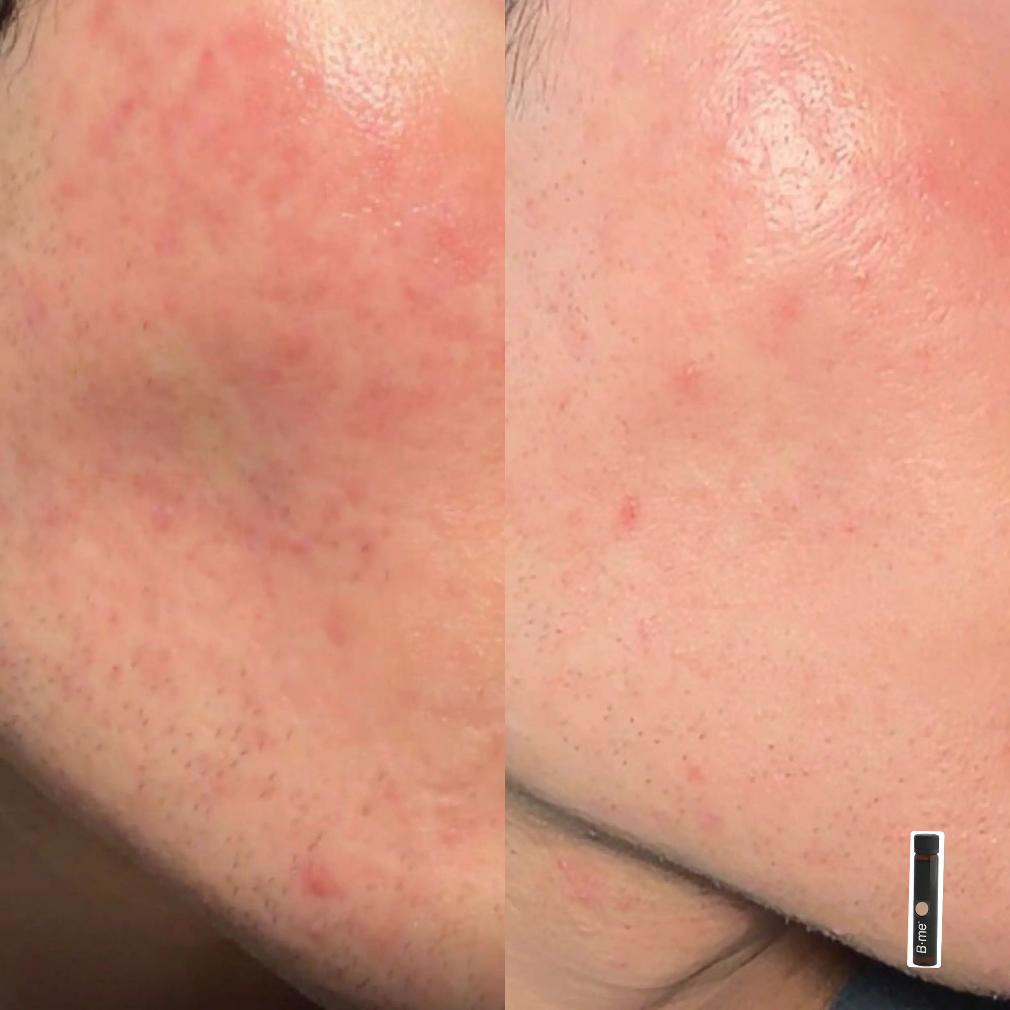 Before and after showing reduced redness smoother skin texture and fewer breakouts after using B.me Gentle Skin