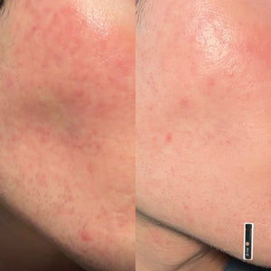 Before and after showing reduced redness smoother skin texture and fewer breakouts after using B.me Gentle Skin
